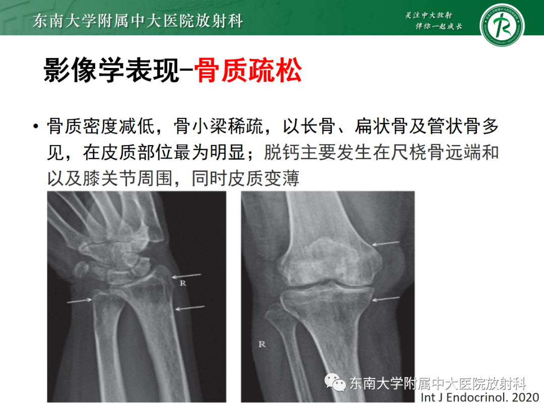 影像PPT - 【PPT】原发性甲状旁腺功能亢进-18 影像PPT - 【PPT】原发性甲状旁腺功能亢进-18