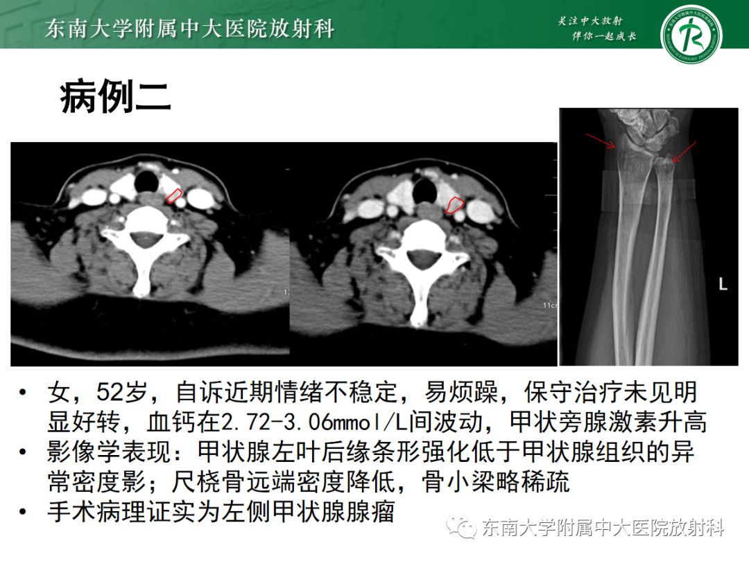 影像PPT - 【PPT】原发性甲状旁腺功能亢进-19 影像PPT - 【PPT】原发性甲状旁腺功能亢进-19