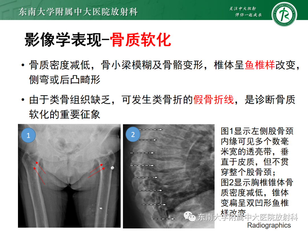 影像PPT - 【PPT】原发性甲状旁腺功能亢进-20 影像PPT - 【PPT】原发性甲状旁腺功能亢进-20