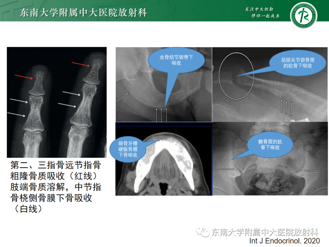 影像PPT - 【PPT】原发性甲状旁腺功能亢进-22 影像PPT - 【PPT】原发性甲状旁腺功能亢进-22
