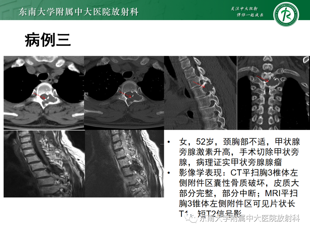影像PPT - 【PPT】原发性甲状旁腺功能亢进-24 影像PPT - 【PPT】原发性甲状旁腺功能亢进-24