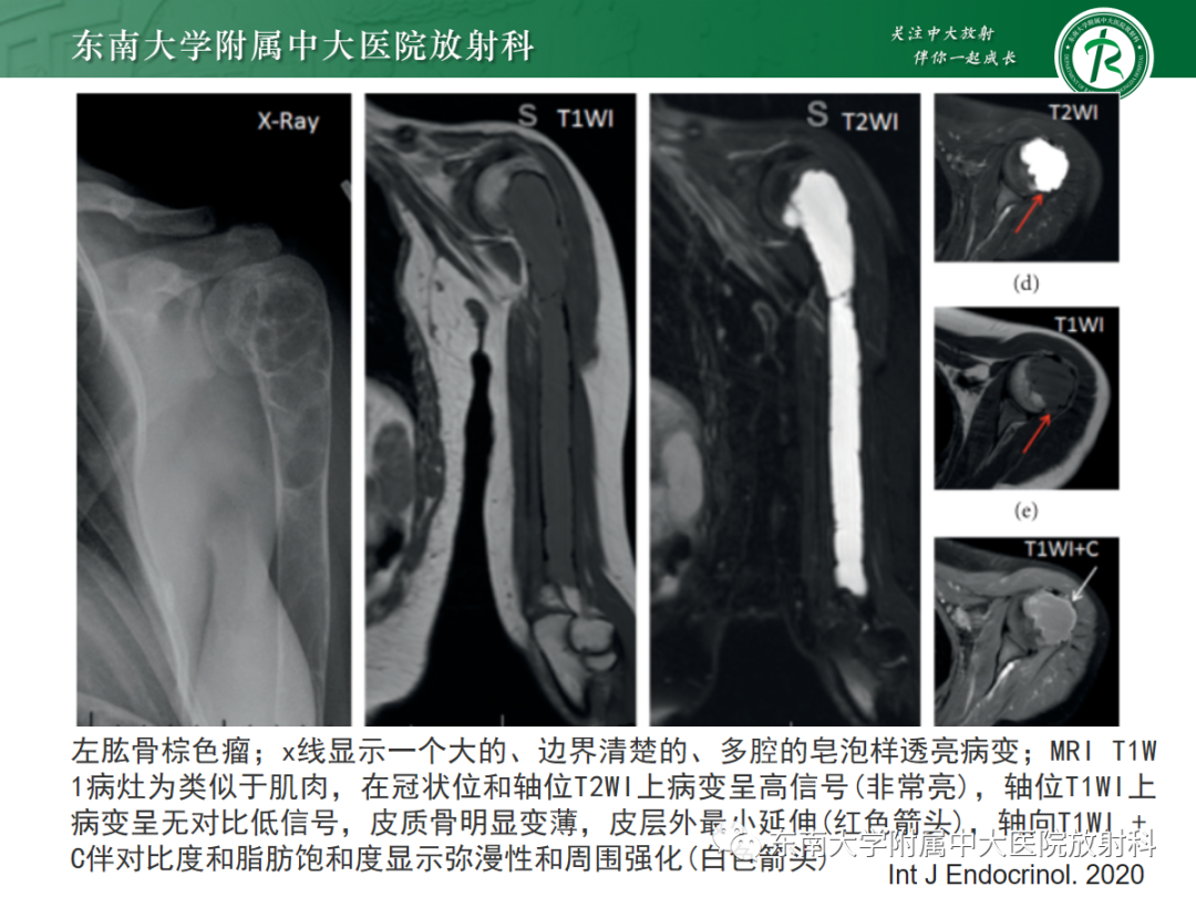 影像PPT - 【PPT】原发性甲状旁腺功能亢进-25 影像PPT - 【PPT】原发性甲状旁腺功能亢进-25