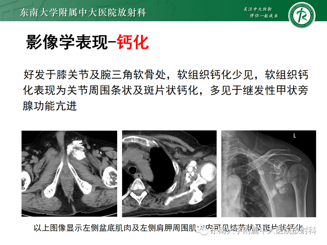 影像PPT - 【PPT】原发性甲状旁腺功能亢进-26 影像PPT - 【PPT】原发性甲状旁腺功能亢进-26