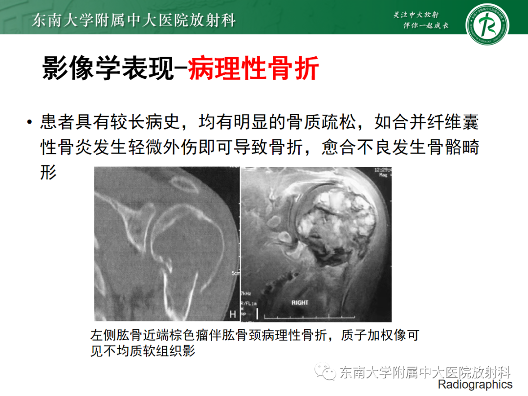 影像PPT - 【PPT】原发性甲状旁腺功能亢进-27 影像PPT - 【PPT】原发性甲状旁腺功能亢进-27