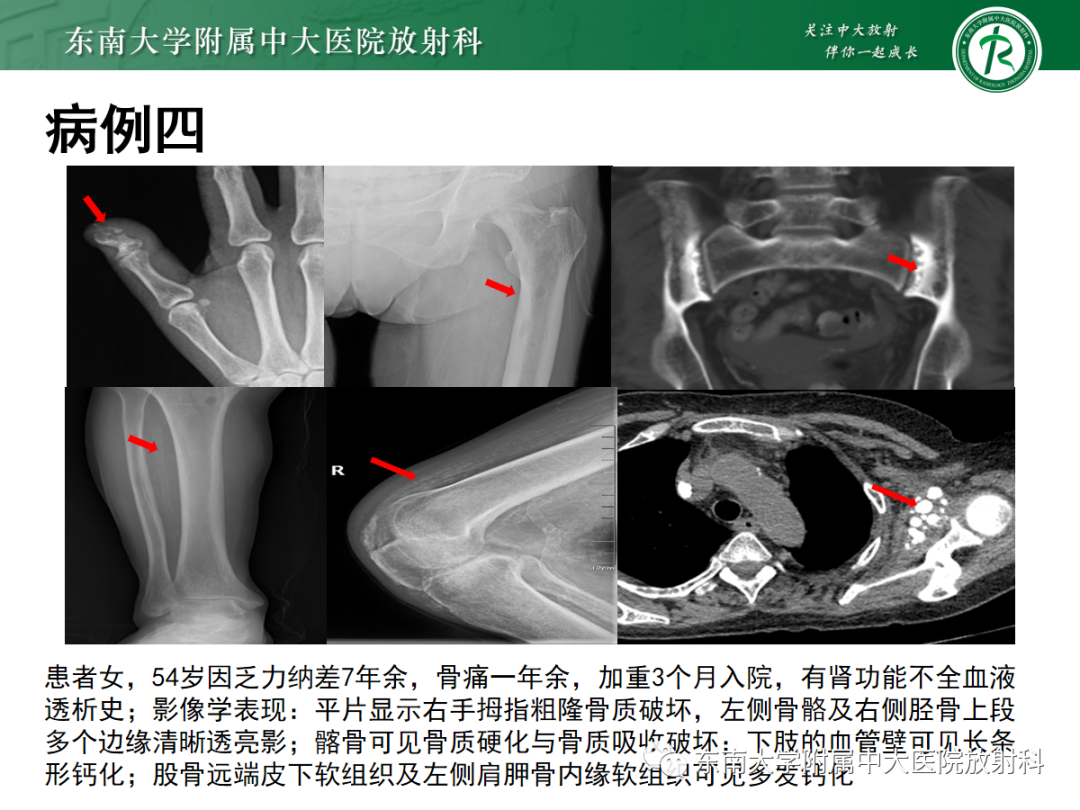 影像PPT - 【PPT】原发性甲状旁腺功能亢进-29 影像PPT - 【PPT】原发性甲状旁腺功能亢进-29