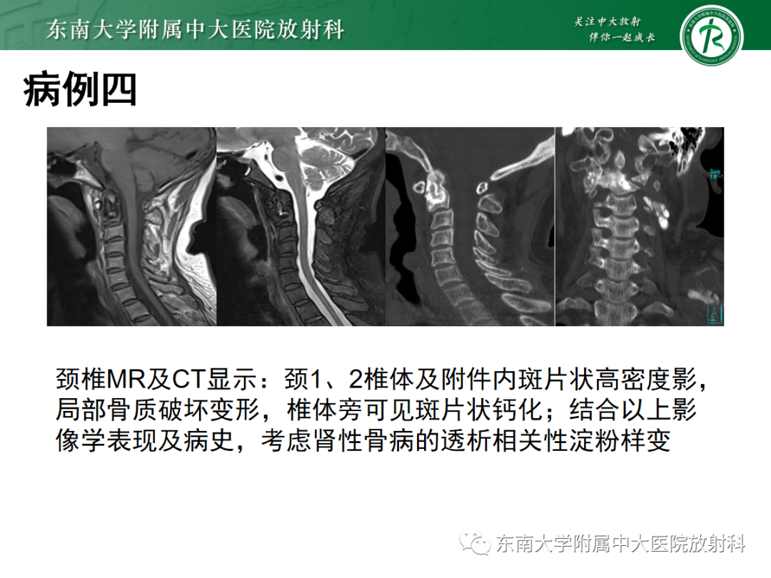 影像PPT - 【PPT】原发性甲状旁腺功能亢进-30 影像PPT - 【PPT】原发性甲状旁腺功能亢进-30