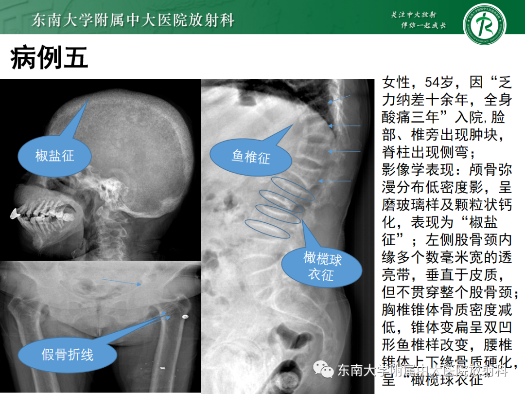 影像PPT - 【PPT】原发性甲状旁腺功能亢进-31 影像PPT - 【PPT】原发性甲状旁腺功能亢进-31
