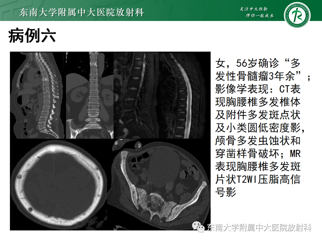 影像PPT - 【PPT】原发性甲状旁腺功能亢进-33 影像PPT - 【PPT】原发性甲状旁腺功能亢进-33