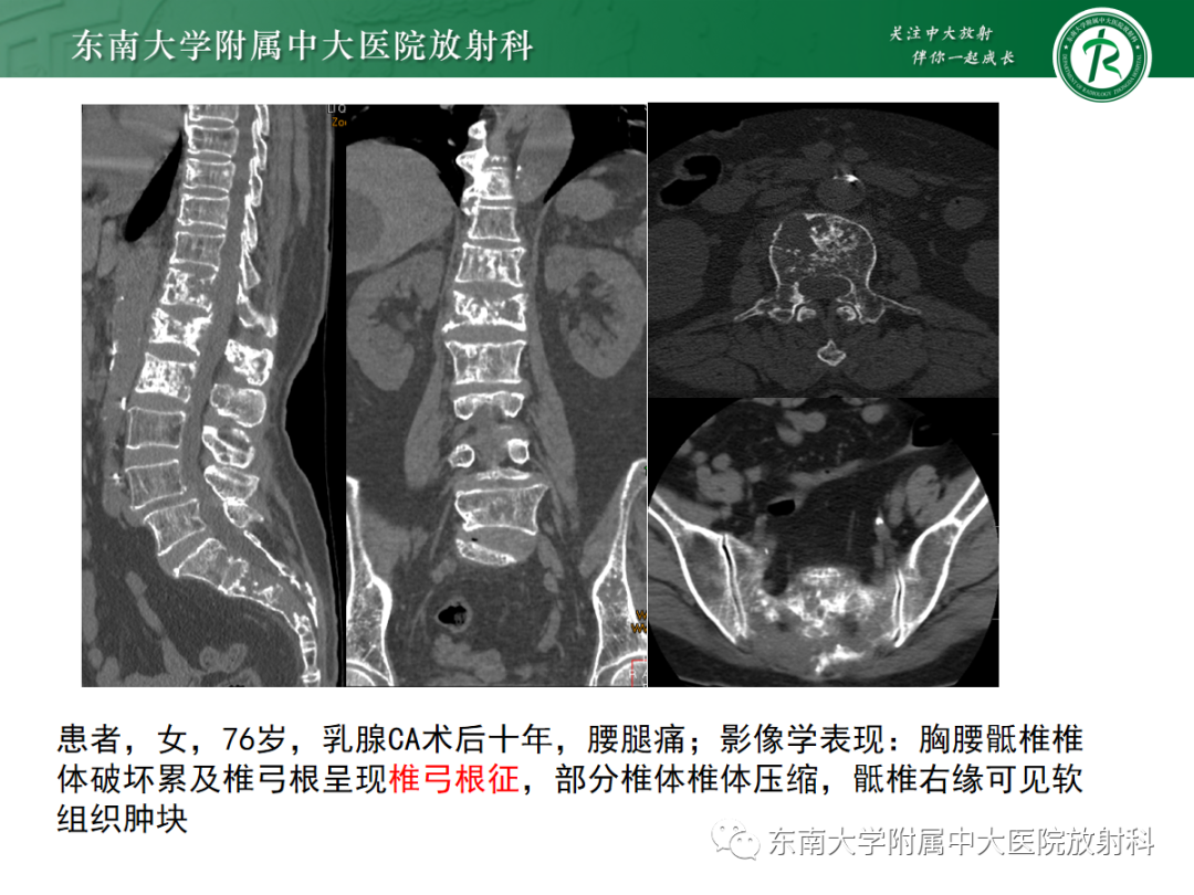影像PPT - 【PPT】原发性甲状旁腺功能亢进-35 影像PPT - 【PPT】原发性甲状旁腺功能亢进-35