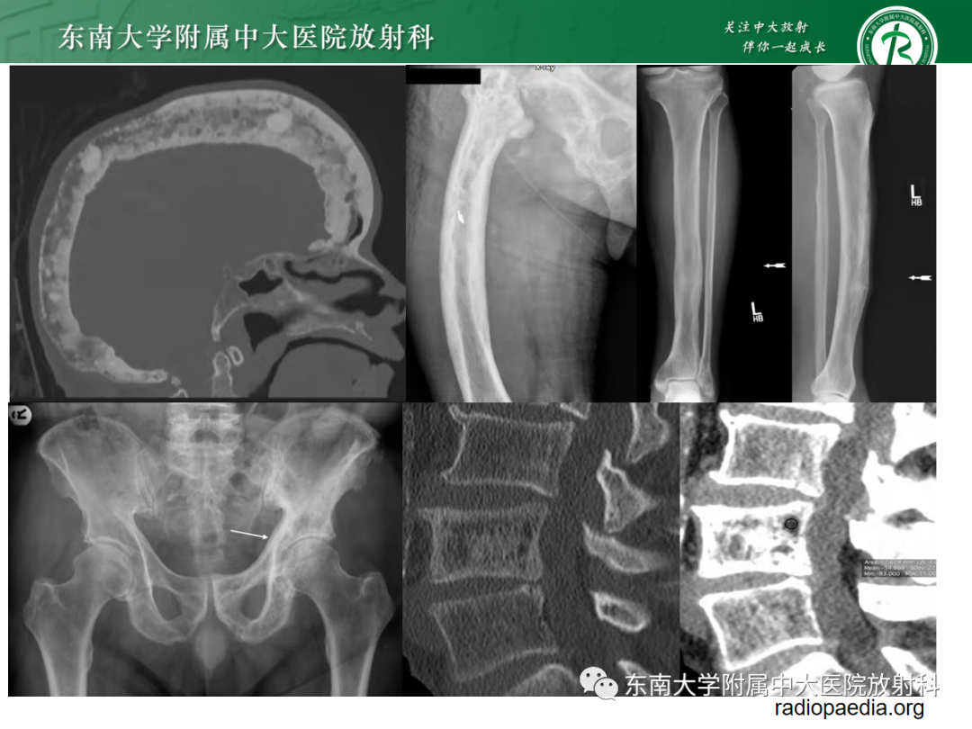 影像PPT - 【PPT】原发性甲状旁腺功能亢进-37 影像PPT - 【PPT】原发性甲状旁腺功能亢进-37