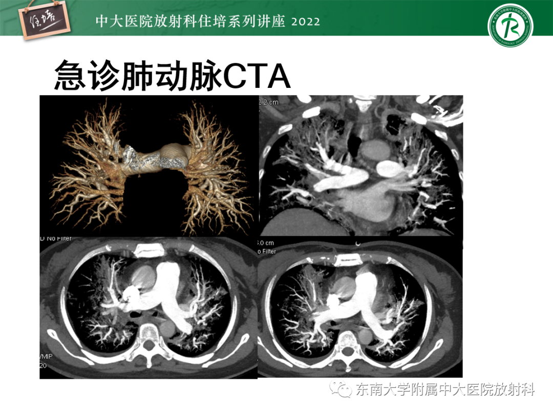 影像PPT - 【PPT】胸部病例读片——蝶翼征-3