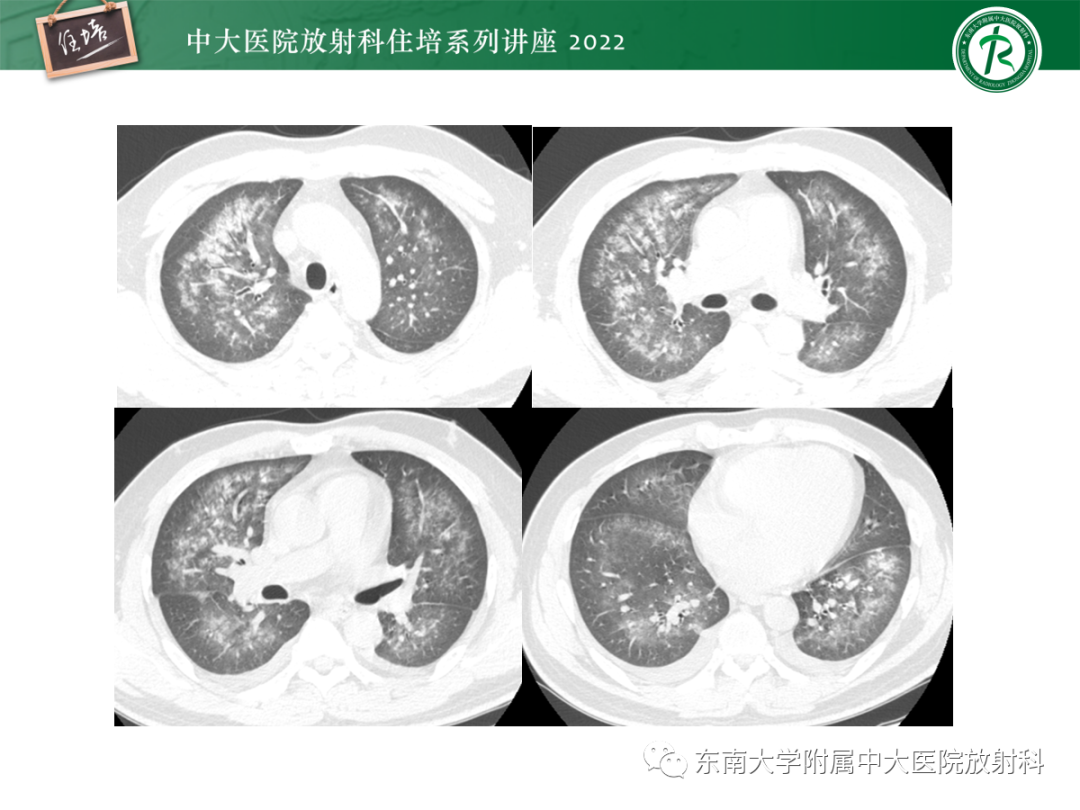 影像PPT - 【PPT】胸部病例读片——蝶翼征-9