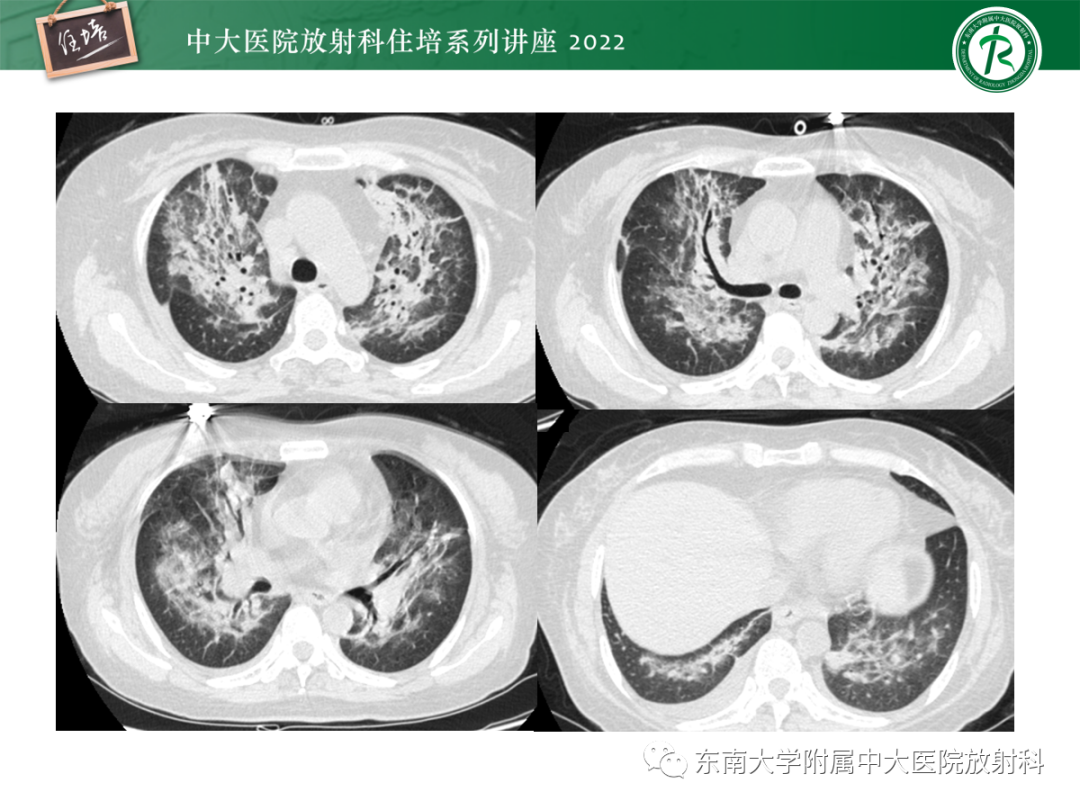 影像PPT - 【PPT】胸部病例读片——蝶翼征-4