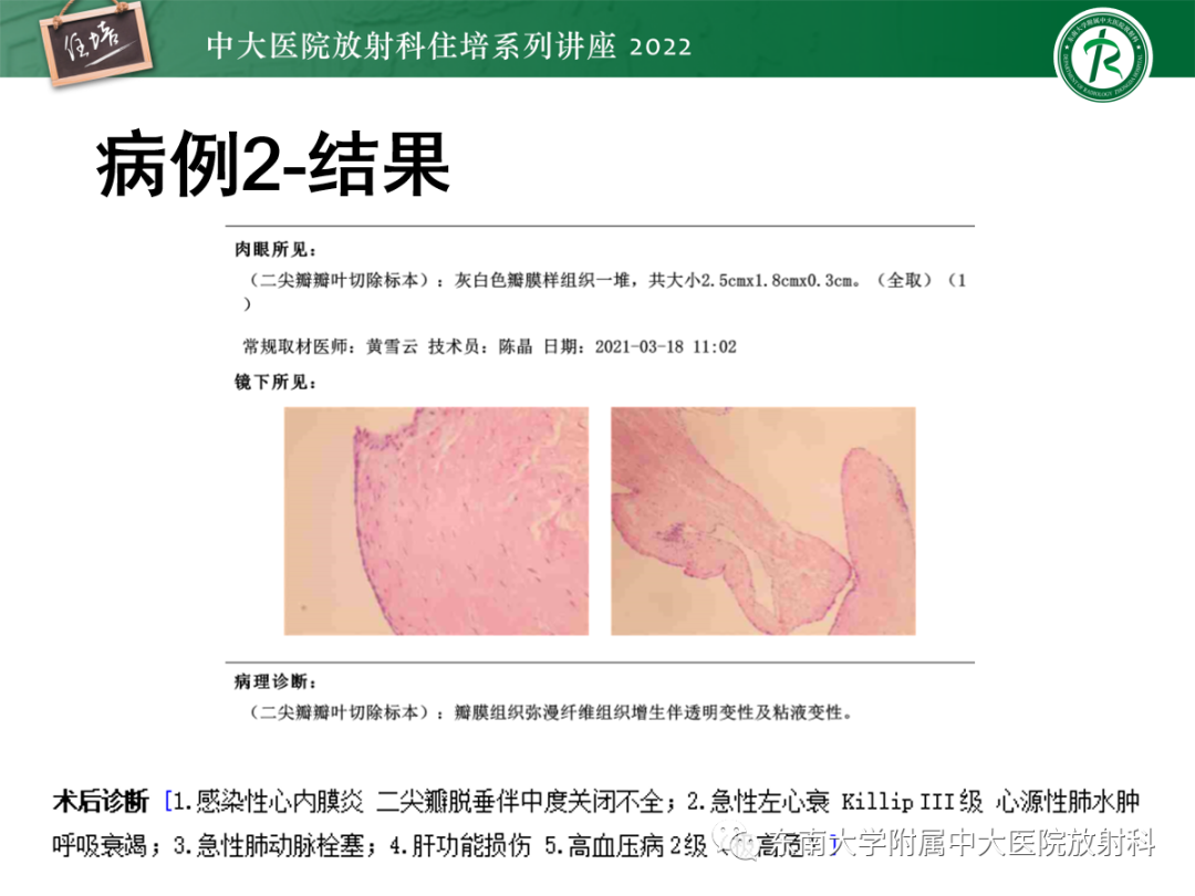 影像PPT - 【PPT】胸部病例读片——蝶翼征-11