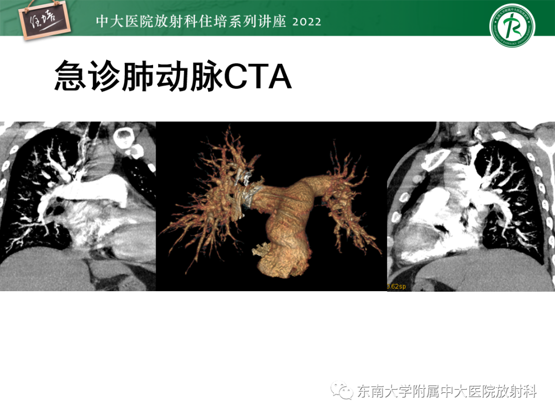 影像PPT - 【PPT】胸部病例读片——蝶翼征-8