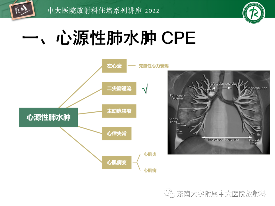 影像PPT - 【PPT】胸部病例读片——蝶翼征-15