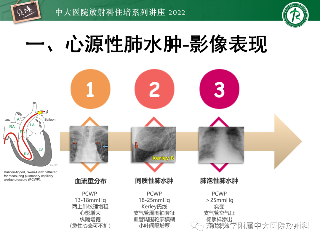 影像PPT - 【PPT】胸部病例读片——蝶翼征-16