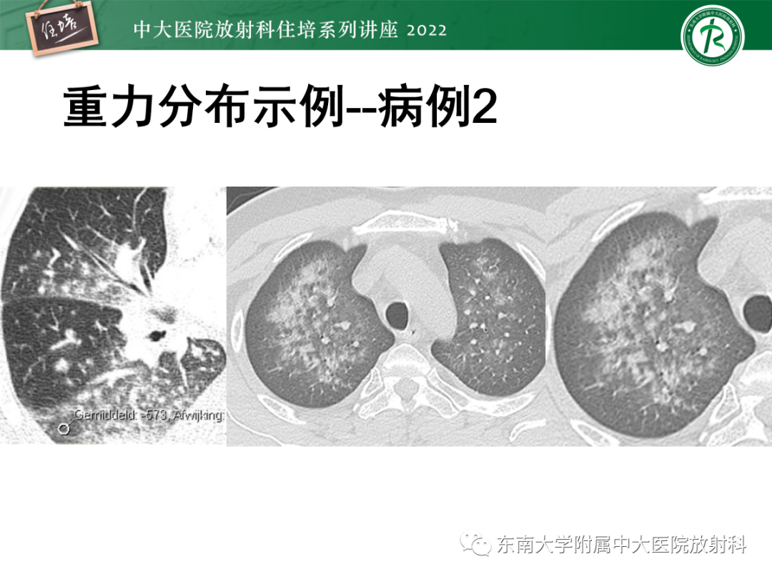 影像PPT - 【PPT】胸部病例读片——蝶翼征-17