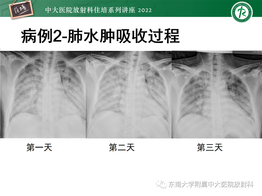 影像PPT - 【PPT】胸部病例读片——蝶翼征-18