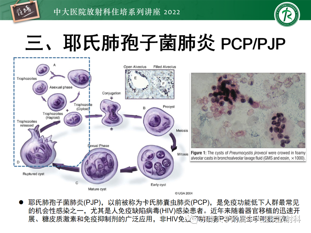 影像PPT - 【PPT】胸部病例读片——蝶翼征-21