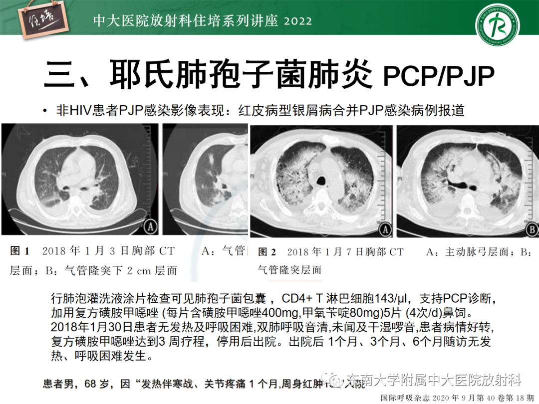 影像PPT - 【PPT】胸部病例读片——蝶翼征-24