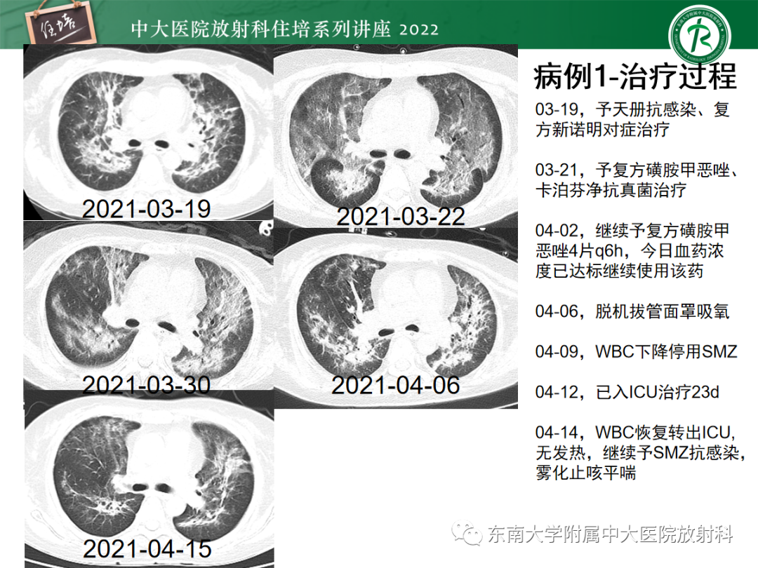 影像PPT - 【PPT】胸部病例读片——蝶翼征-25