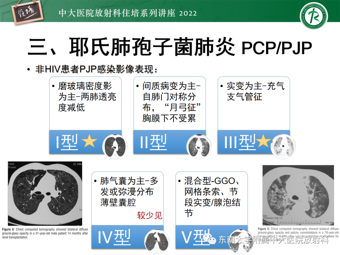 影像PPT - 【PPT】胸部病例读片——蝶翼征-23