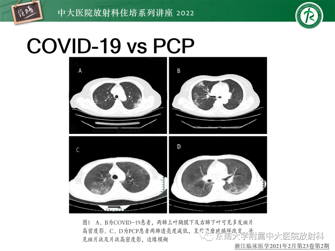 影像PPT - 【PPT】胸部病例读片——蝶翼征-28