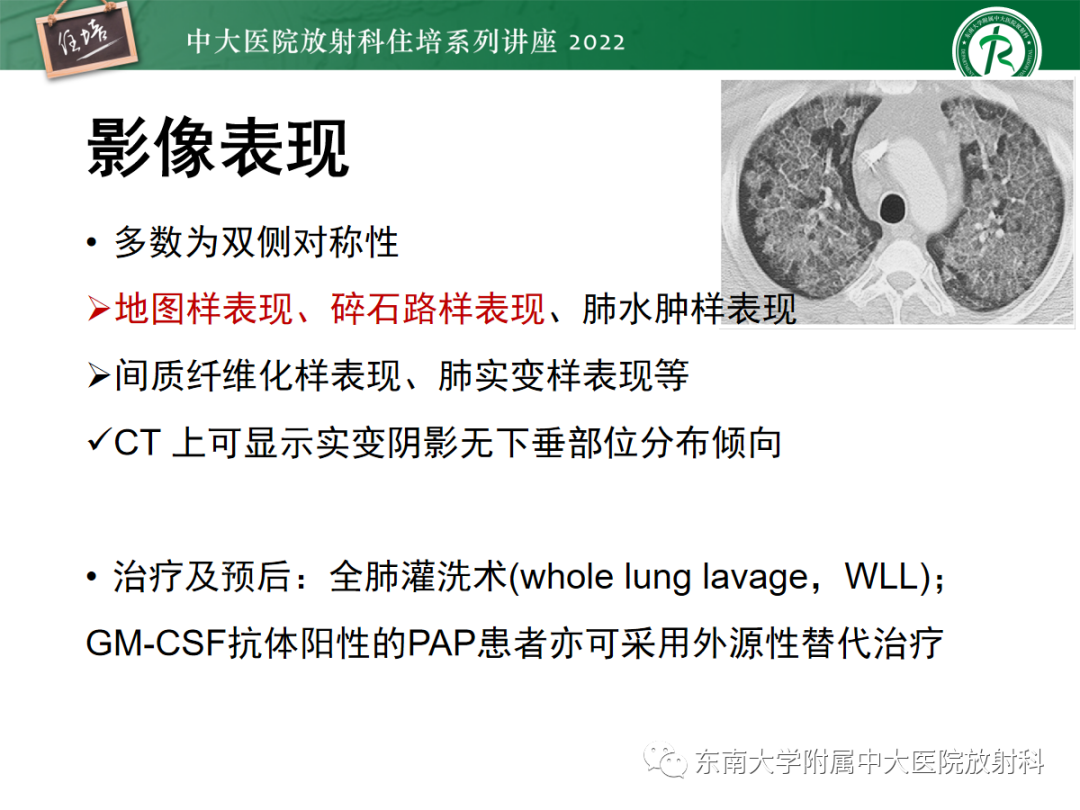 影像PPT - 【PPT】胸部病例读片——蝶翼征-30