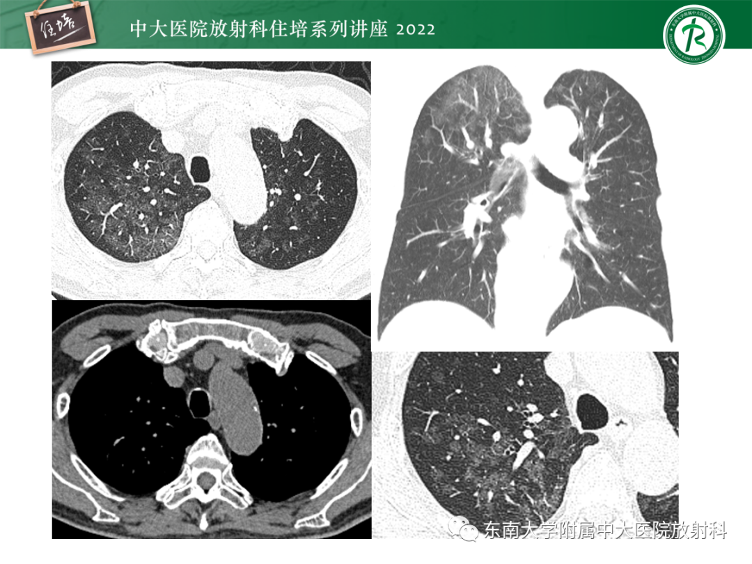 影像PPT - 【PPT】胸部病例读片——蝶翼征-34