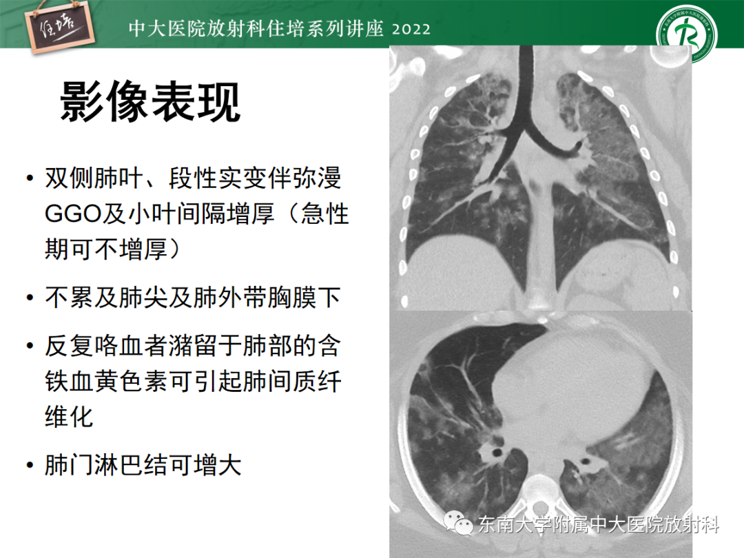 影像PPT - 【PPT】胸部病例读片——蝶翼征-43