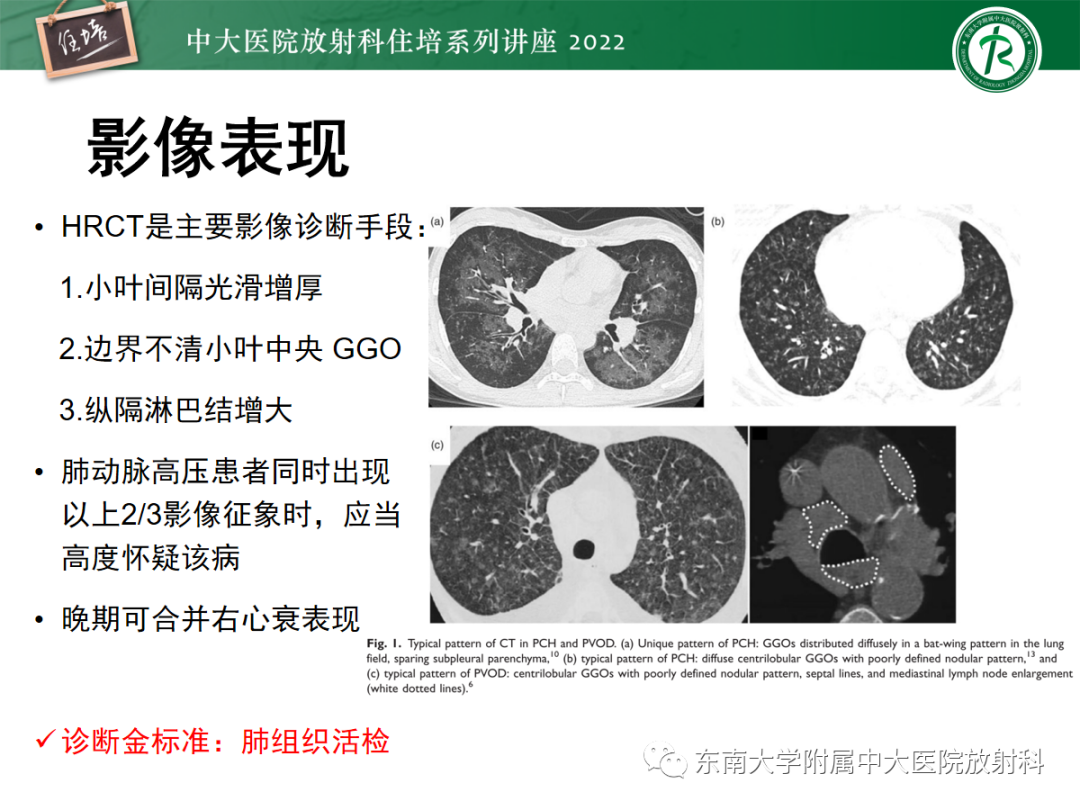 影像PPT - 【PPT】胸部病例读片——蝶翼征-46