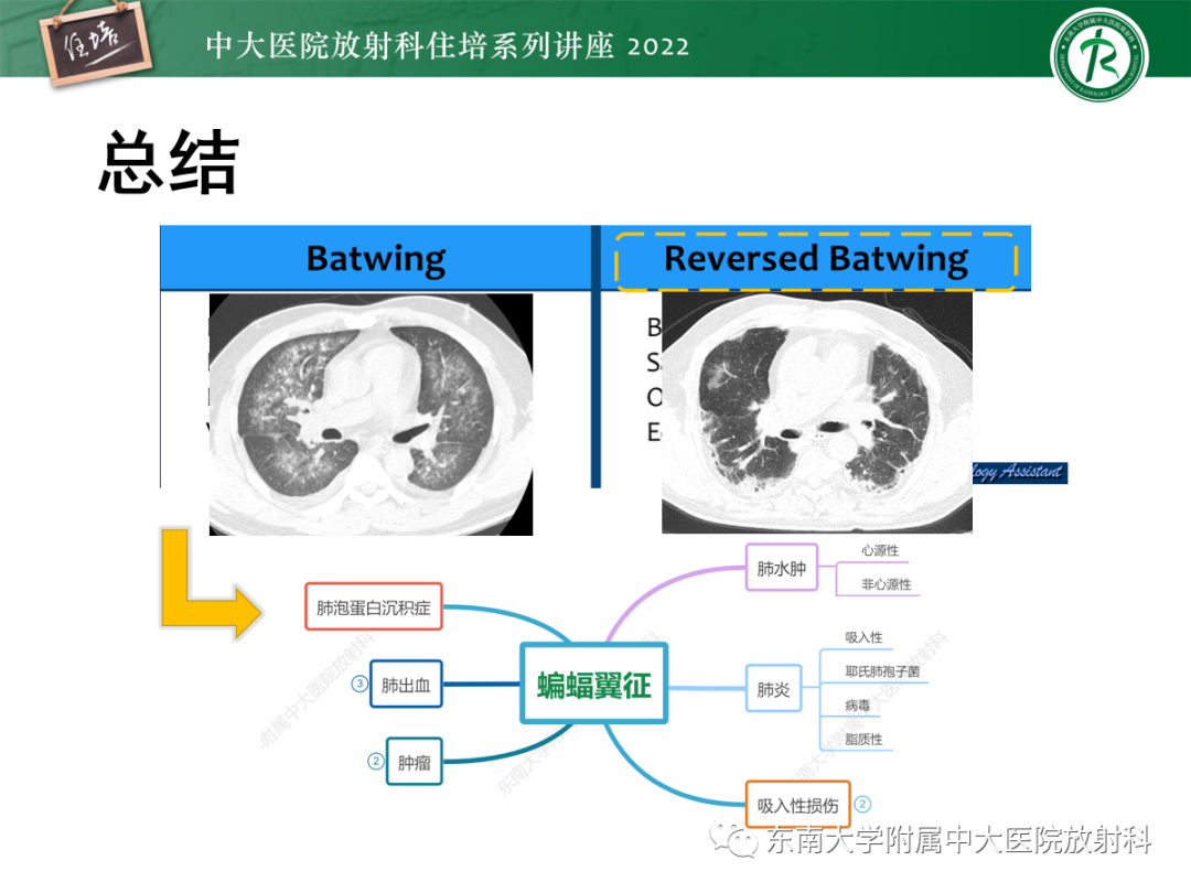 影像PPT - 【PPT】胸部病例读片——蝶翼征-47