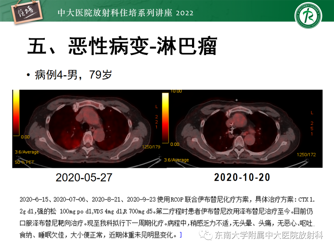 影像PPT - 【PPT】胸部病例读片——蝶翼征-38