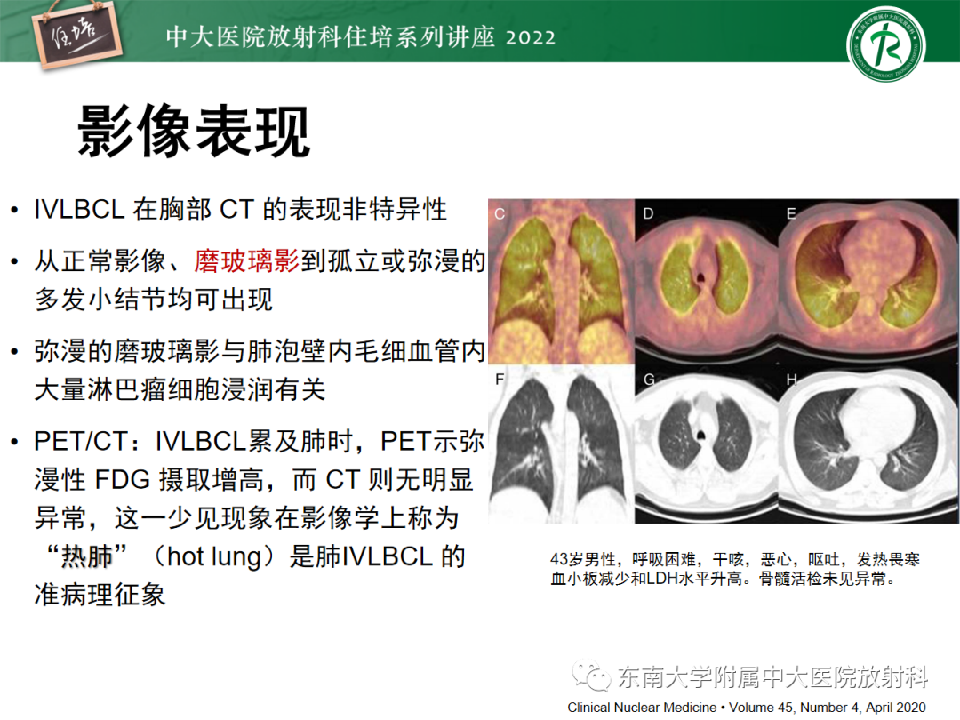 影像PPT - 【PPT】胸部病例读片——蝶翼征-37