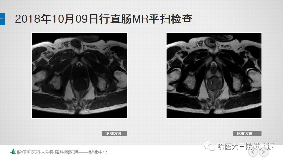 影像PPT - 【PPT】直肠神经内分泌肿瘤-8