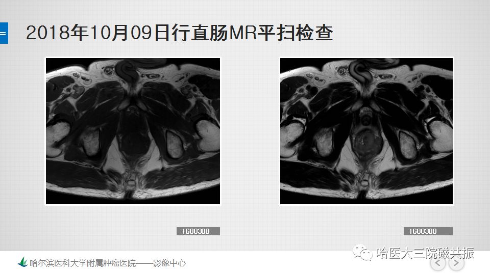 影像PPT - 【PPT】直肠神经内分泌肿瘤-9