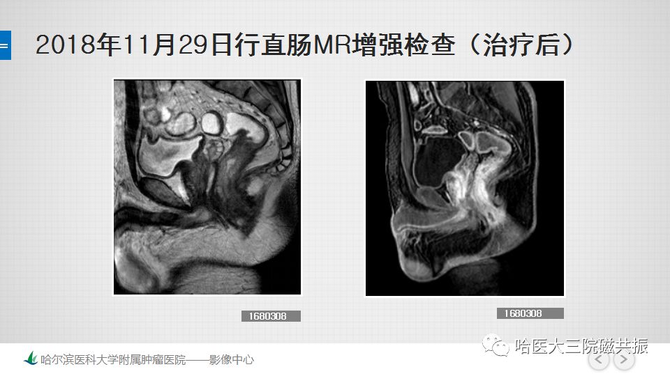 影像PPT - 【PPT】直肠神经内分泌肿瘤-11