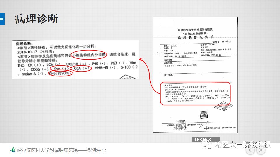 影像PPT - 【PPT】直肠神经内分泌肿瘤-14