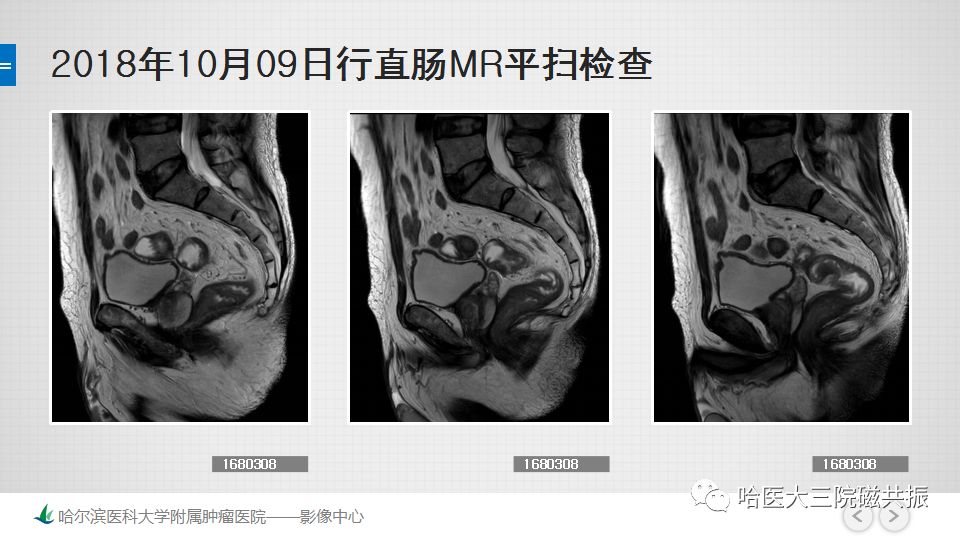 影像PPT - 【PPT】直肠神经内分泌肿瘤-7