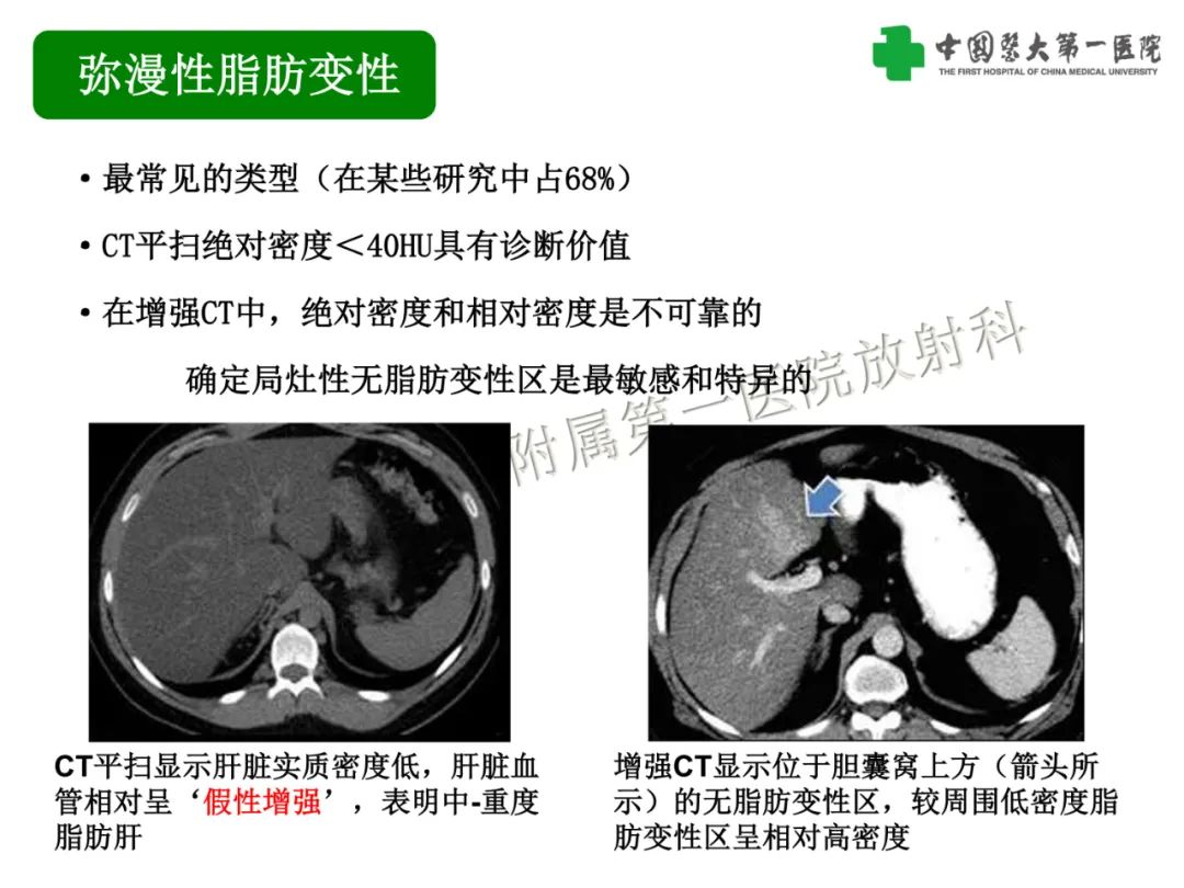 影像PPT - 【PPT】是脂是敌？肝脏良性含脂病变与相似的恶性病变鉴别诊断-7