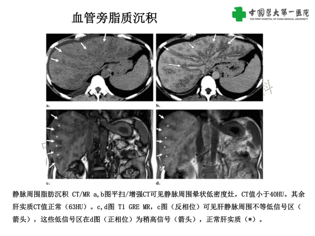 影像PPT - 【PPT】是脂是敌？肝脏良性含脂病变与相似的恶性病变鉴别诊断-5