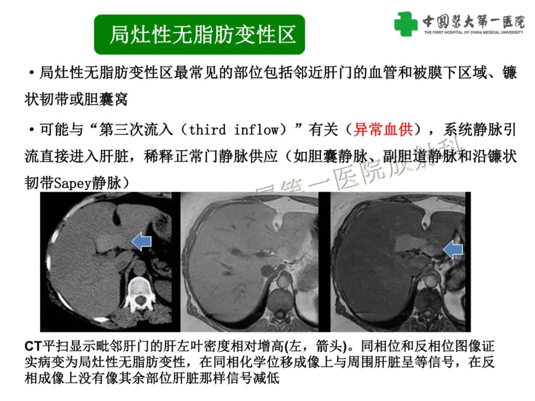 影像PPT - 【PPT】是脂是敌？肝脏良性含脂病变与相似的恶性病变鉴别诊断-9
