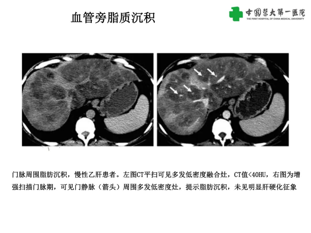 影像PPT - 【PPT】是脂是敌？肝脏良性含脂病变与相似的恶性病变鉴别诊断-6