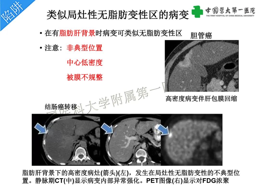 影像PPT - 【PPT】是脂是敌？肝脏良性含脂病变与相似的恶性病变鉴别诊断-10
