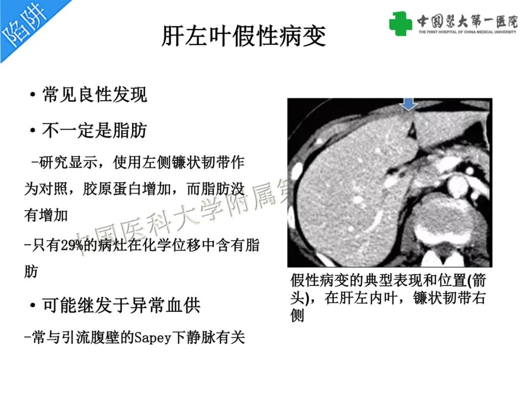 影像PPT - 【PPT】是脂是敌？肝脏良性含脂病变与相似的恶性病变鉴别诊断-12