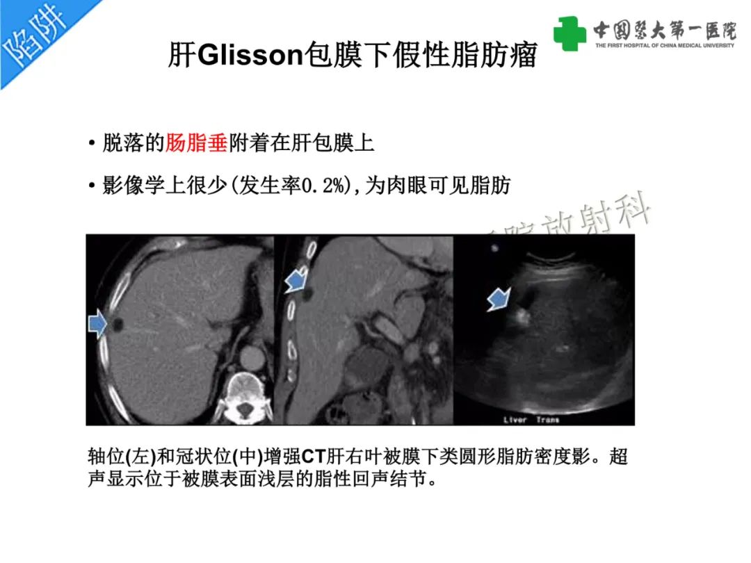 影像PPT - 【PPT】是脂是敌？肝脏良性含脂病变与相似的恶性病变鉴别诊断-13