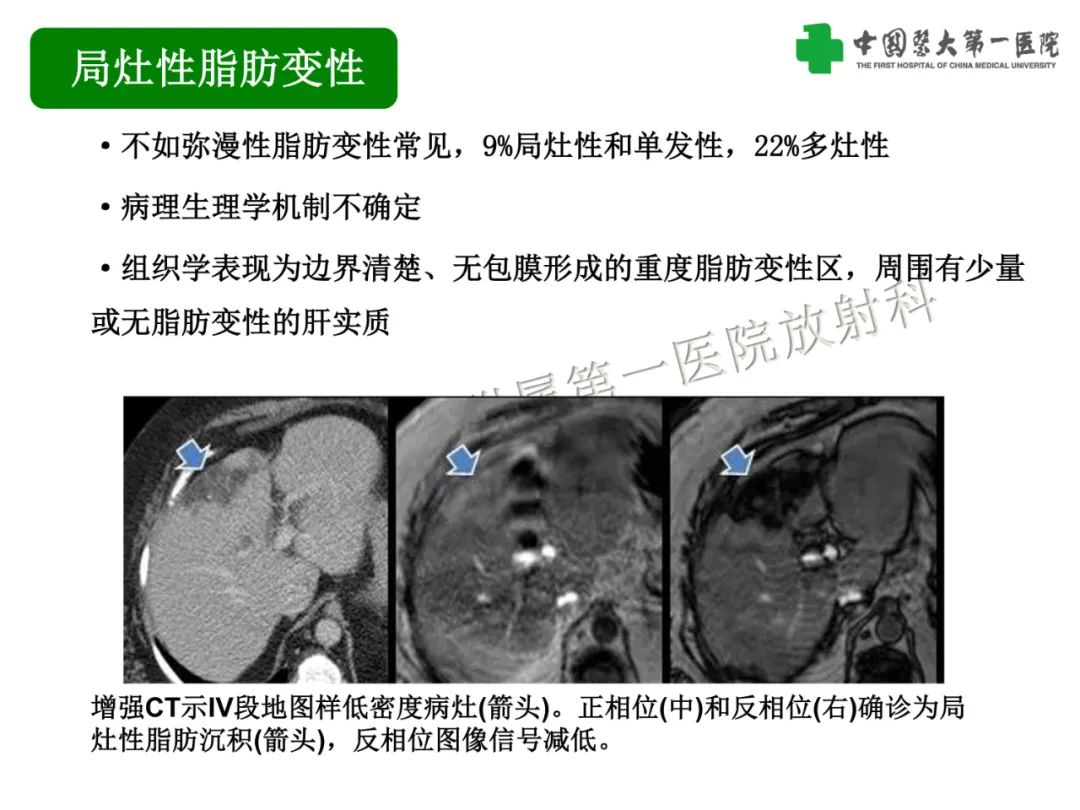 影像PPT - 【PPT】是脂是敌？肝脏良性含脂病变与相似的恶性病变鉴别诊断-11