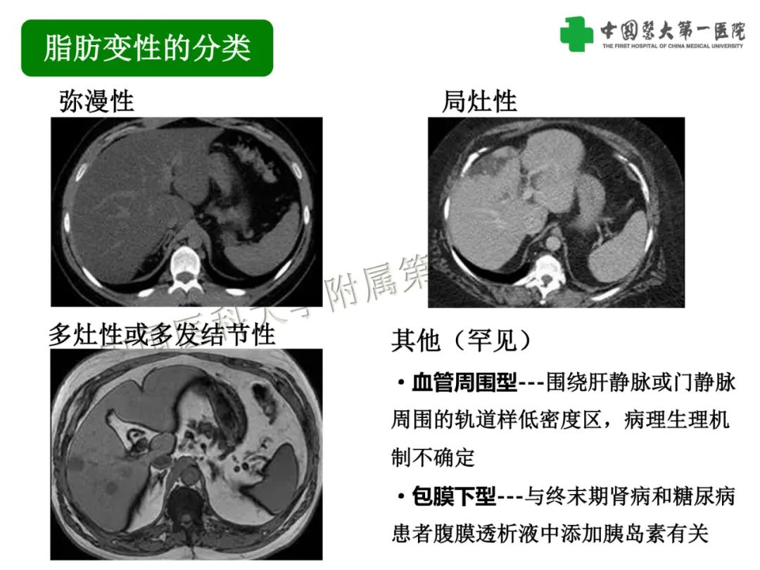 影像PPT - 【PPT】是脂是敌？肝脏良性含脂病变与相似的恶性病变鉴别诊断-4