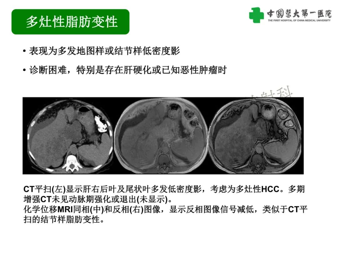 影像PPT - 【PPT】是脂是敌？肝脏良性含脂病变与相似的恶性病变鉴别诊断-14